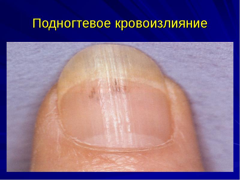 Подногтевое кровоизлияние Подногтевое кровоизлияние