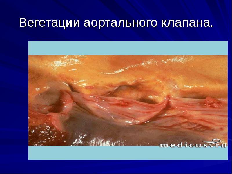 Вегетации аортального клапана. Вегетации аортального клапана.