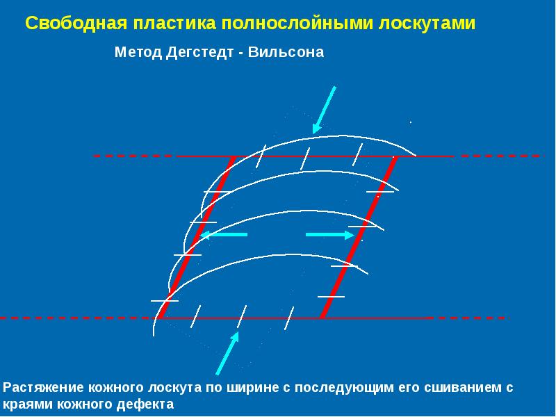 Свободный лоскут. Свободная кожная пластика полнослойным лоскутом. Свободная пластика кожи. Пластика свободным кожным лоскутом. Пластика кожи полнослойным кожным лоскутом.