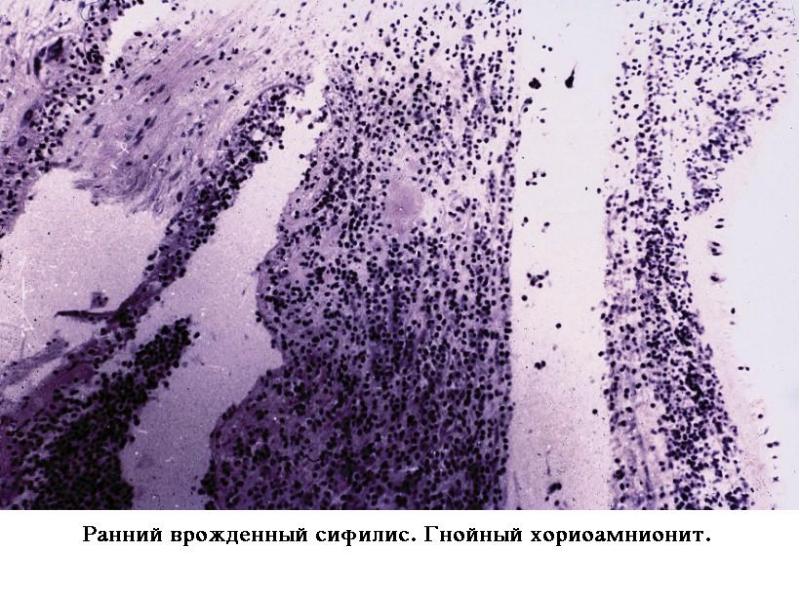 Сифилис Показать Фото