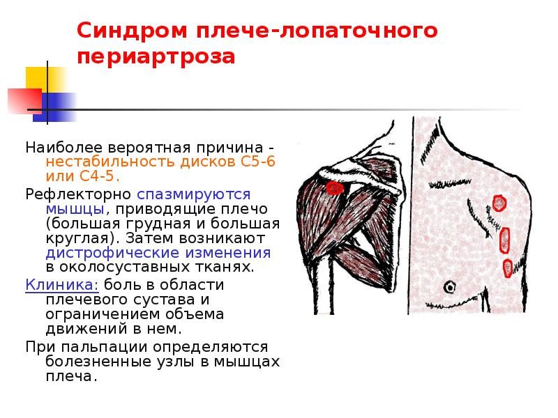 Плече или плечо. Плечелопаточный периартрит импиджмент синдром. Субакромиальный импичмент синдром плечевого сустава. Импиджмент синдром левого плечевого сустава. Импичмент синдром плечевого сустава это.