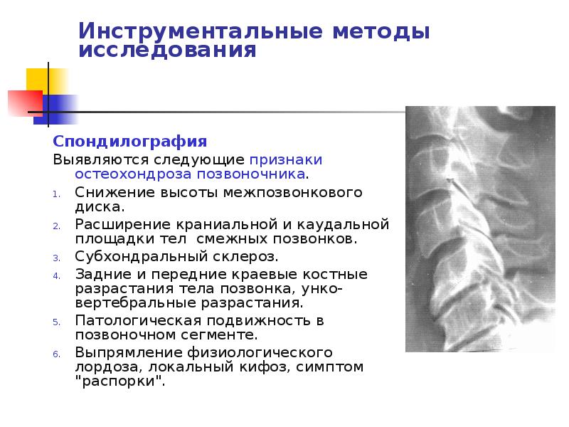 Полисегментарный спондилез. Методы исследования остеохондроза позвоночника. Высота межпозвонковых дисков снижена. Снижение высоты диска. Снижение высоты диска 6-7.