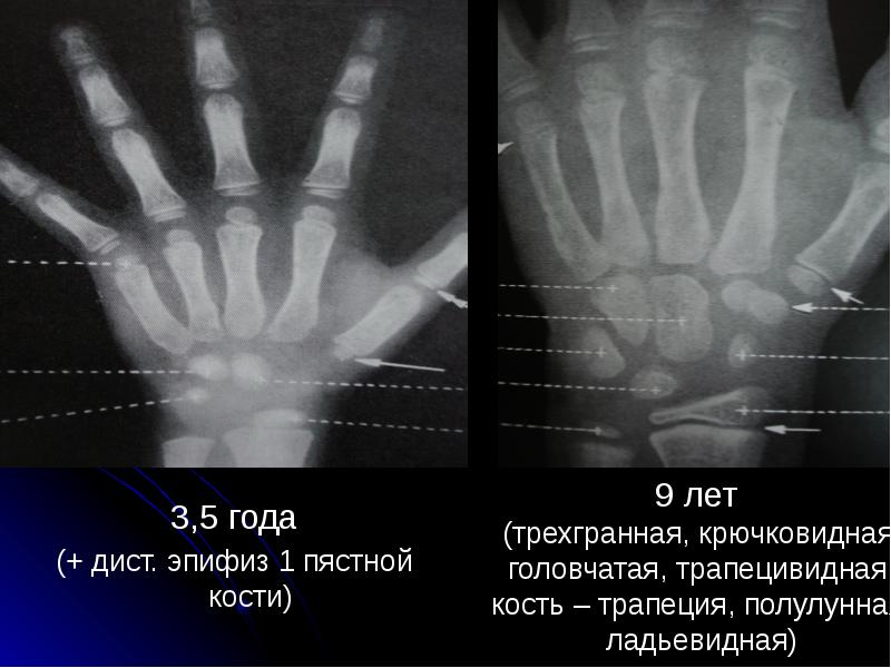 3,5 года 3,5 года (+ дист. эпифиз 1 пястной кости)