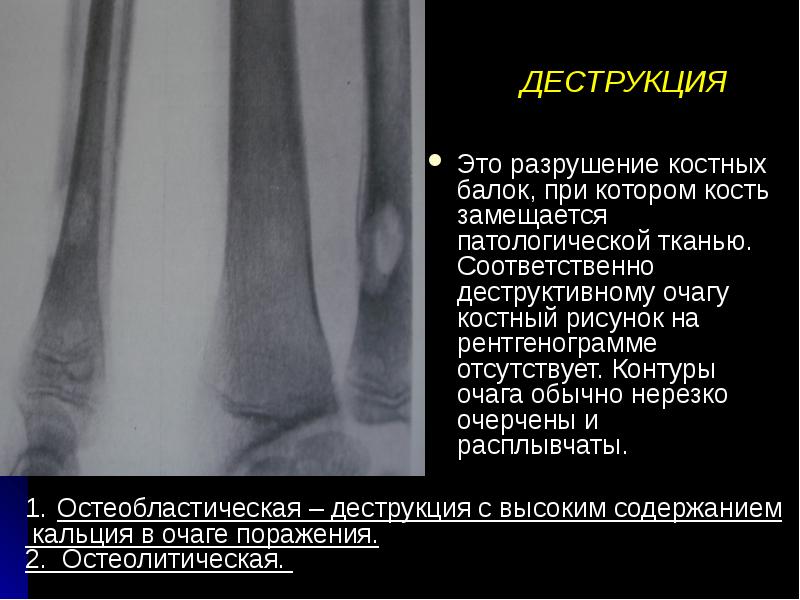 ДЕСТРУКЦИЯ  Это разрушение костных балок, при котором кость замещается патологической