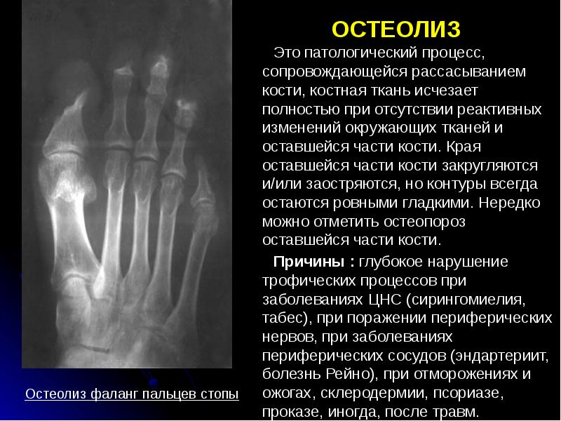 ОСТЕОЛИЗ  Это патологический процесс, сопровождающейся рассасыванием кости, костная ткань исчезает