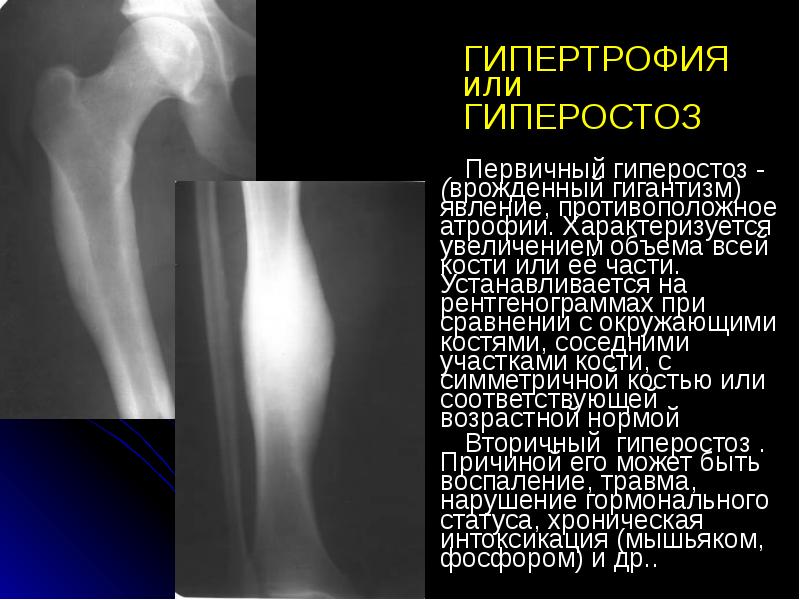 ГИПЕРТРОФИЯ или  ГИПЕРОСТОЗ  Первичный гиперостоз - (врожденный гигантизм) явление,
