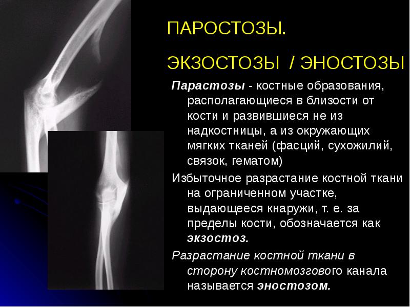 ПАРОСТОЗЫ.  ЭКЗОСТОЗЫ / ЭНОСТОЗЫ Парастозы - костные образования, располагающиеся в
