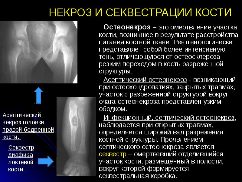 НЕКРОЗ И СЕКВЕСТРАЦИИ КОСТИ  Остеонекроз – это омертвление участка кости,