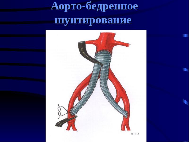 Острая артериальная ишемия презентация