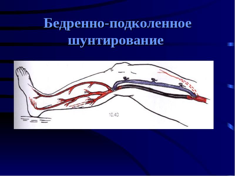 Острая артериальная непроходимость презентация хирургия