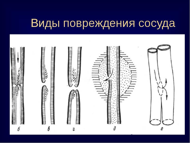 Острая артериальная непроходимость презентация хирургия