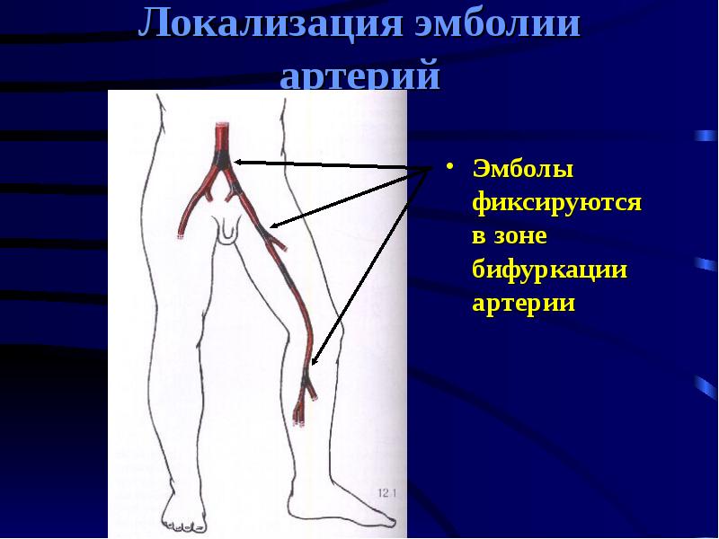 Лечение эмболии артерии. Эмболия артериального сосуда. Эмболэктомия бедренной артерии. Лечение эмболии артерии. Лечение эмболии артерии.