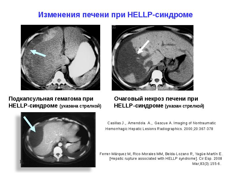 Hellp синдром в акушерстве презентация