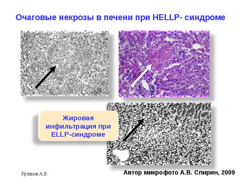 Hellp синдром в акушерстве презентация