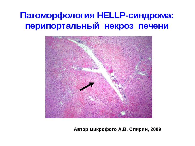 Hellp синдром в акушерстве презентация