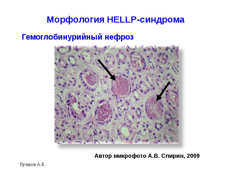 Hellp синдром в акушерстве презентация