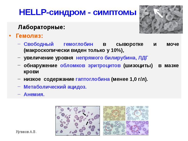 Hellp синдром в акушерстве презентация