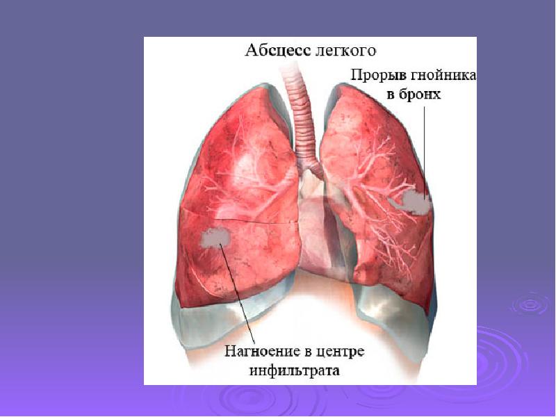 Абсцесс легкого процесс. Эмфизема пневмосклероз.