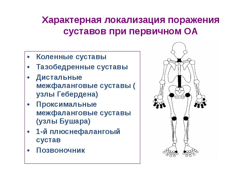 Презентация на тему артрозы