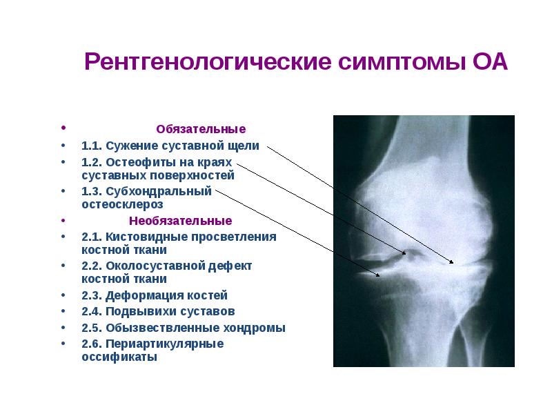 Презентация на тему артрозы