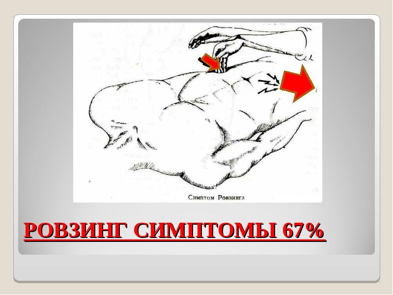 Бартомье михельсона. Симптомы острого аппендицита (Ровзинга. Симптом Ровзинга и Ситковского. Симптомы аппендицита Ровзин.