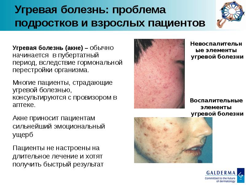 Профилактика угревой сыпи презентация