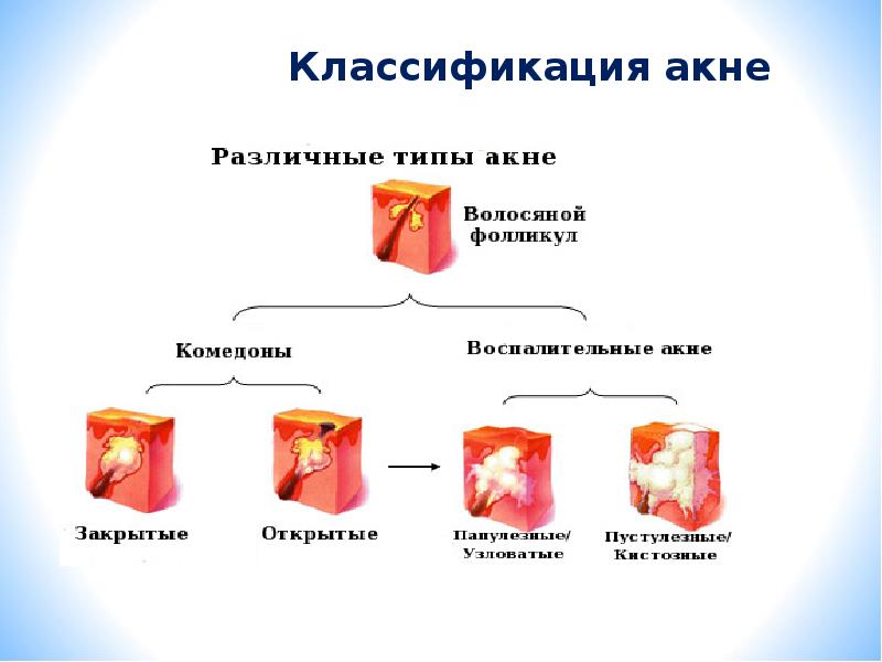 Профилактика угревой сыпи презентация