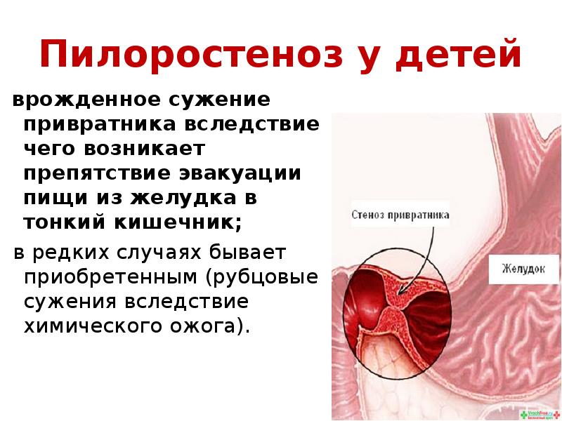 Врожденный пилоростеноз презентация