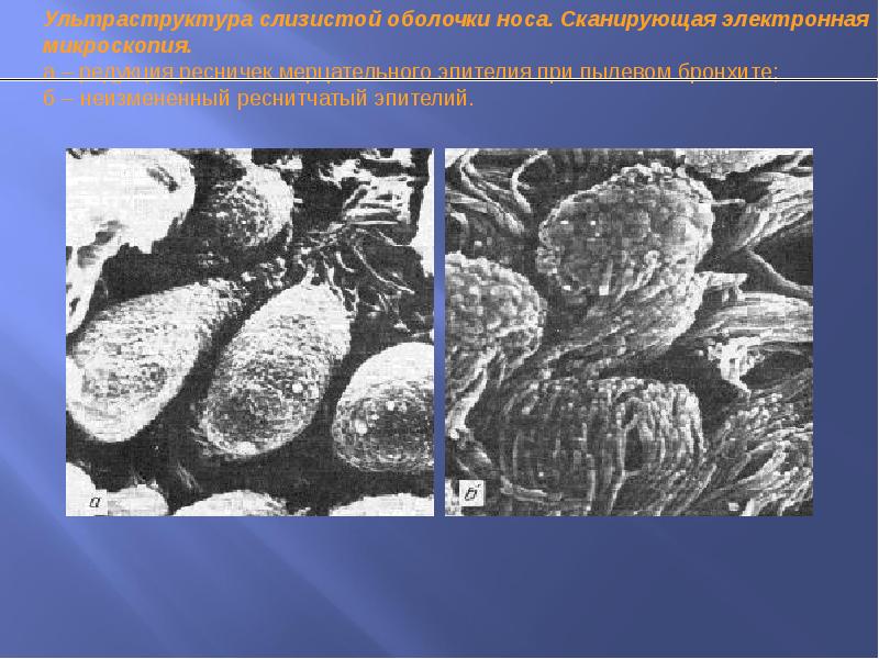 Патология клетки. Мерцательный эпителий электронная микроскопия. Электронная микроскопия реснитчатого эпителия. Ультраструктура реснитчатого эпителиоцита.