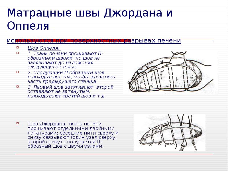 Хирургические швы презентация