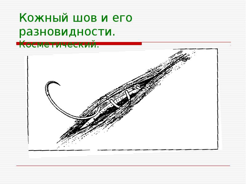 Виды хирургических швов презентация