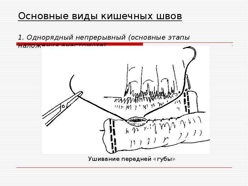 Кишечный шов. Классический вариант наложения кишечного шва на тонкой кишке:. Однорядный непрерывный кишечный шов. Однорядный кишечный шов техника. Основные виды кишечных швов.