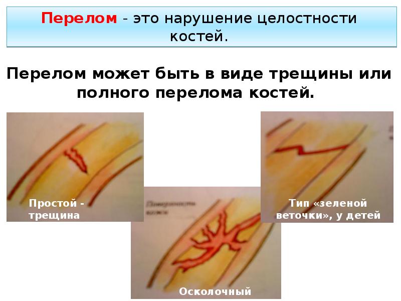Первая помощь при ушибах, вывихах суставов и переломах
