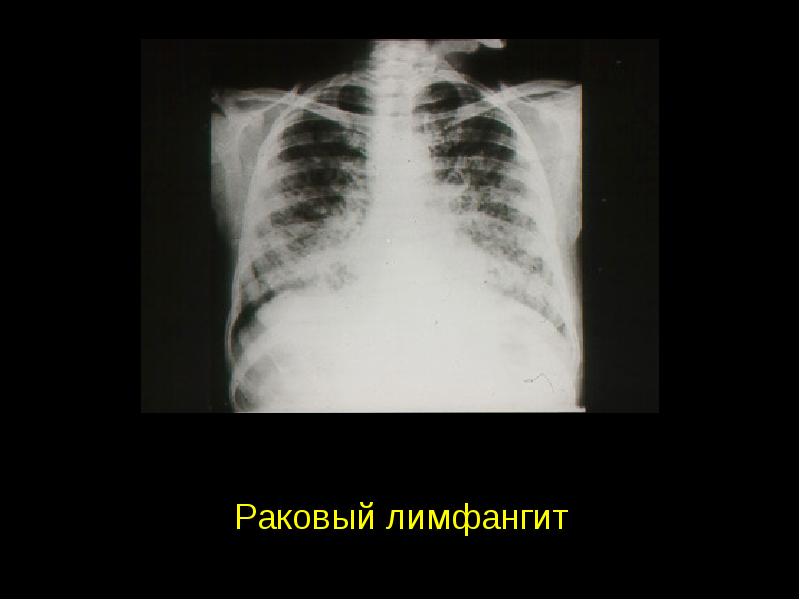 Раковый лимфангит рентгенологическая картина