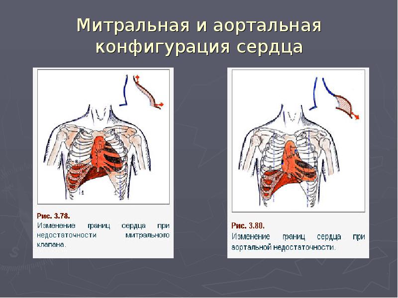 Аортальная конфигурация сердца