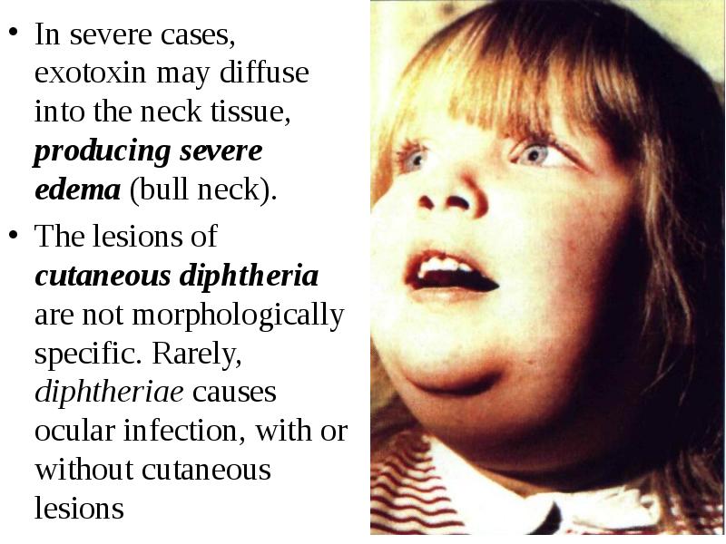 The diseases with tonsilitis. Diphtheria and infectious mononucleosis/