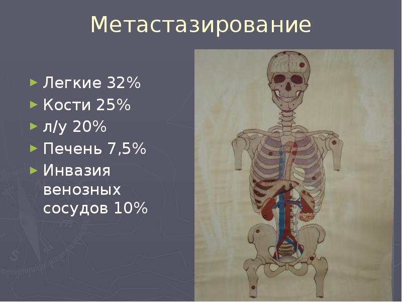 Метастазирование
Легкие 32%
Кости 25%
л/у 20%
Печень 7,5%
Инвазия венозных Метастазирование
Легкие 32%
Кости 25%
л/у 20%
Печень 7,5%
Инвазия венозных