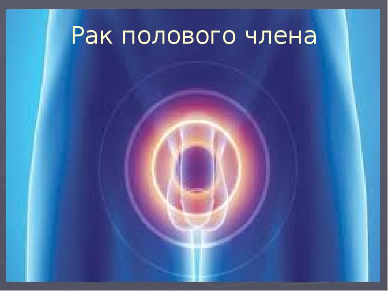 Рак полового члена Рак полового члена