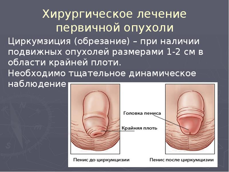 Хирургическое лечение первичной опухоли Хирургическое лечение первичной опухоли
