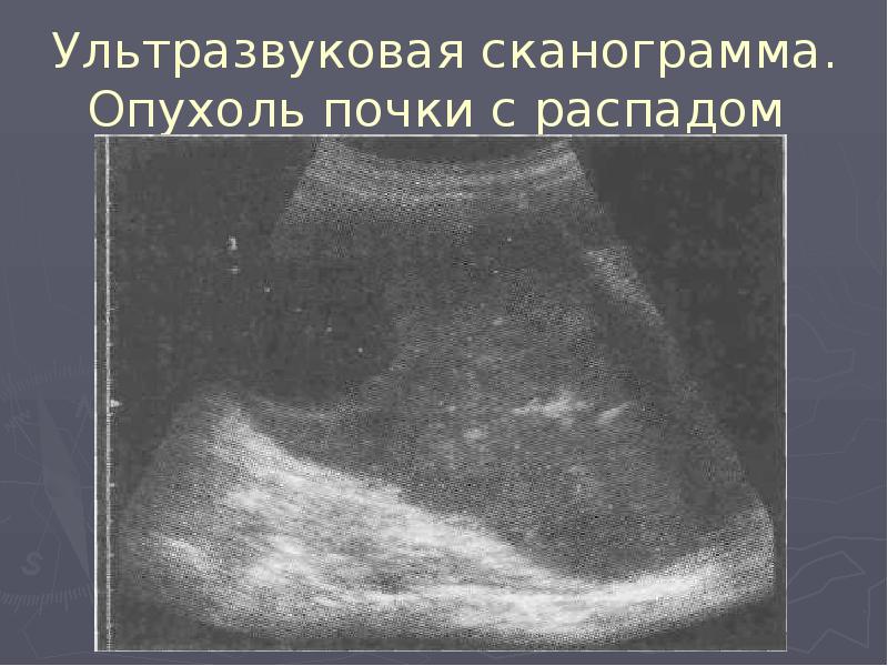 Ультразвуковая сканограмма. Опухоль почки с распадом Ультразвуковая сканограмма. Опухоль почки с распадом