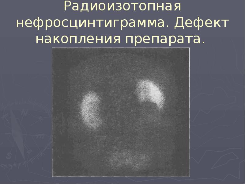Радиоизотопная нефросцинтиграмма. Дефект накопления препарата. Радиоизотопная нефросцинтиграмма. Дефект накопления препарата.