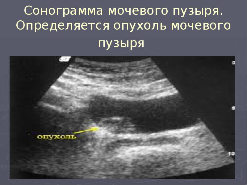 Сонограмма мочевого пузыря. Определяется опухоль мочевого пузыря Сонограмма мочевого пузыря. Определяется опухоль мочевого пузыря