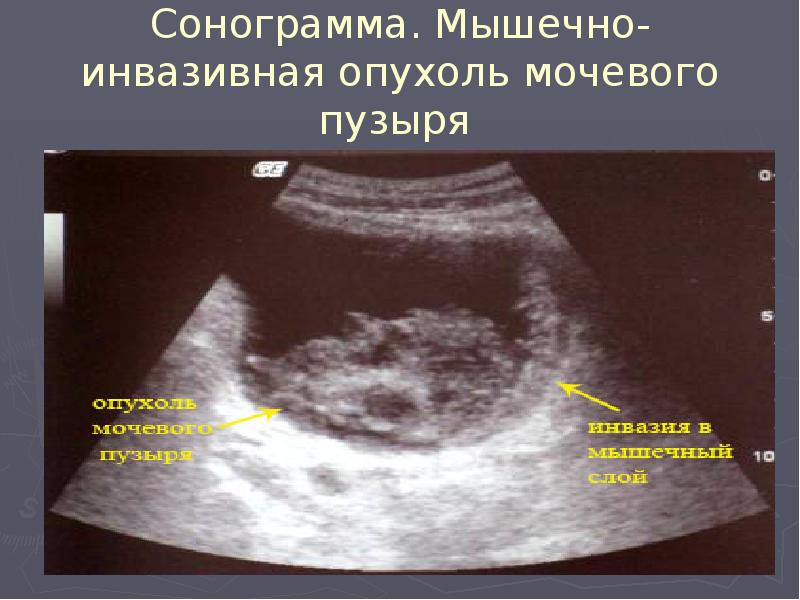 Сонограмма. Мышечно-инвазивная опухоль мочевого пузыря Сонограмма. Мышечно-инвазивная опухоль мочевого пузыря