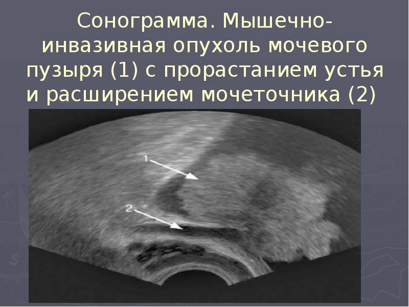 Сонограмма. Мышечно-инвазивная опухоль мочевого пузыря (1) с прорастанием устья и расширением Сонограмма. Мышечно-инвазивная опухоль мочевого пузыря (1) с прорастанием устья и расширением