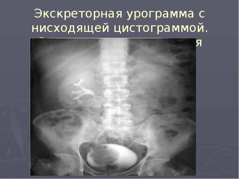 Экскреторная урограмма с нисходящей цистограммой. Опухоль мочевого пузыря Экскреторная урограмма с нисходящей цистограммой. Опухоль мочевого пузыря