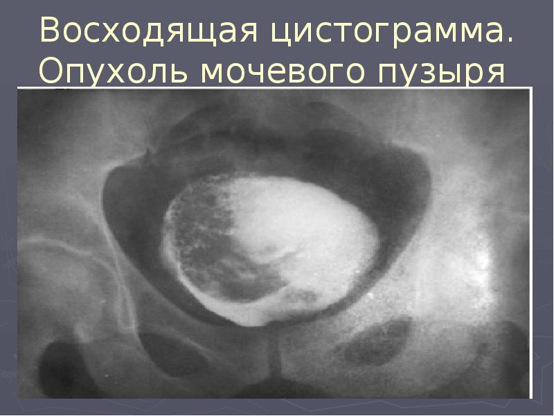 Восходящая цистограмма. Опухоль мочевого пузыря Восходящая цистограмма. Опухоль мочевого пузыря