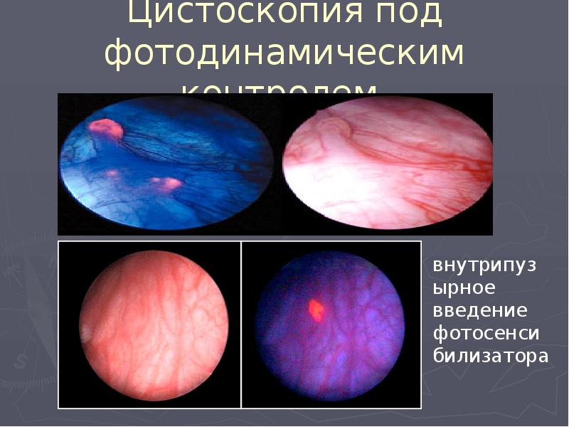 Цистоскопия. Флуоресцентная цистоскопия. Фотодинамическая цистоскопия.