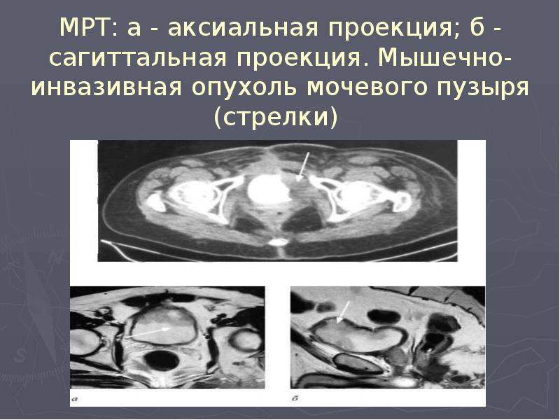 МРТ: а - аксиальная проекция; б - сагиттальная проекция. Мышечно-инвазивная опухоль МРТ: а - аксиальная проекция; б - сагиттальная проекция. Мышечно-инвазивная опухоль