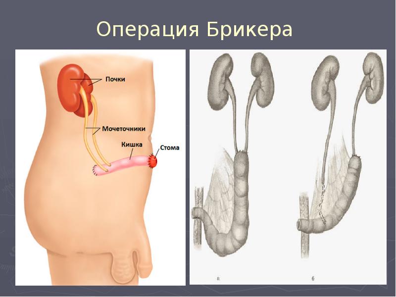 Операция Брикера Операция Брикера