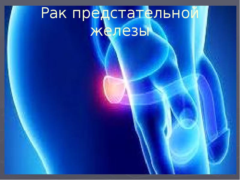 Рак предстательной железы Рак предстательной железы